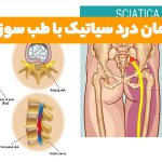 درمان درد سیاتیک با طب سوزنی
