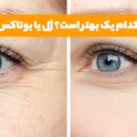 تفاوت ژل و بوتاکس